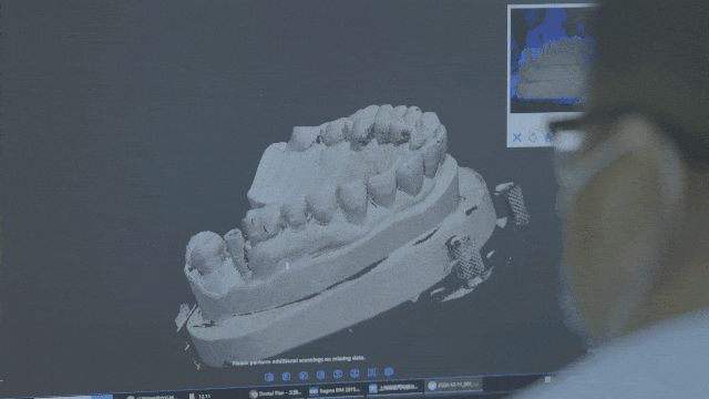3D打印在牙科的應(yīng)用
